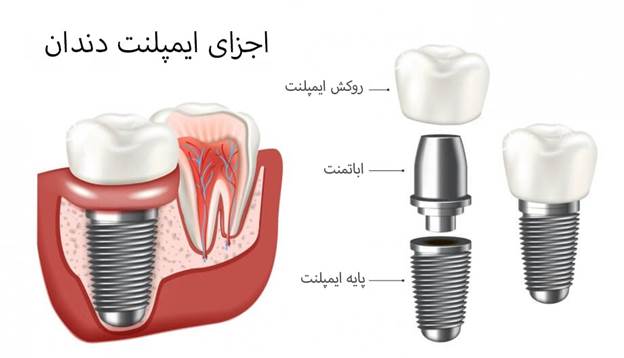 ایملپنت دندان و عوارض 